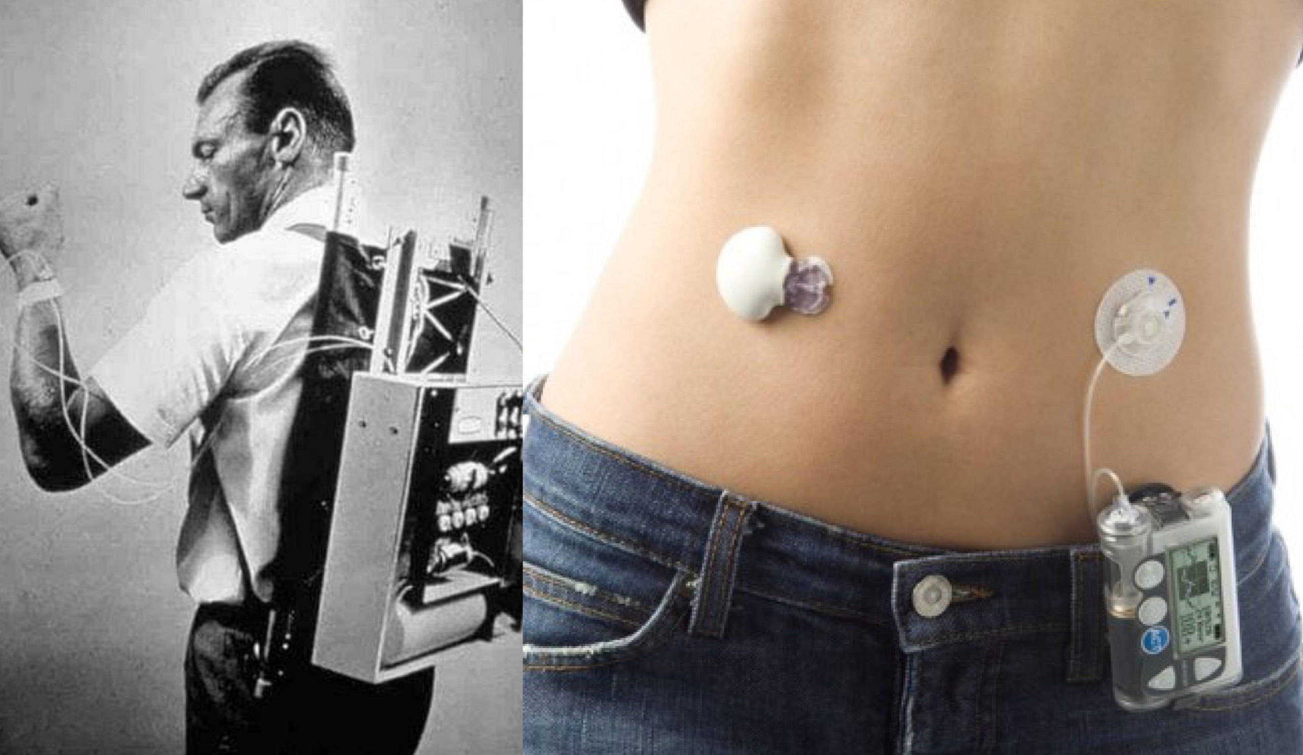 The Biostator may be the world’s first portable insulin pump, but it was completely impractical. It paved the way however, to what we have today – tiny automated devices that take the debilitating out of diabetes.