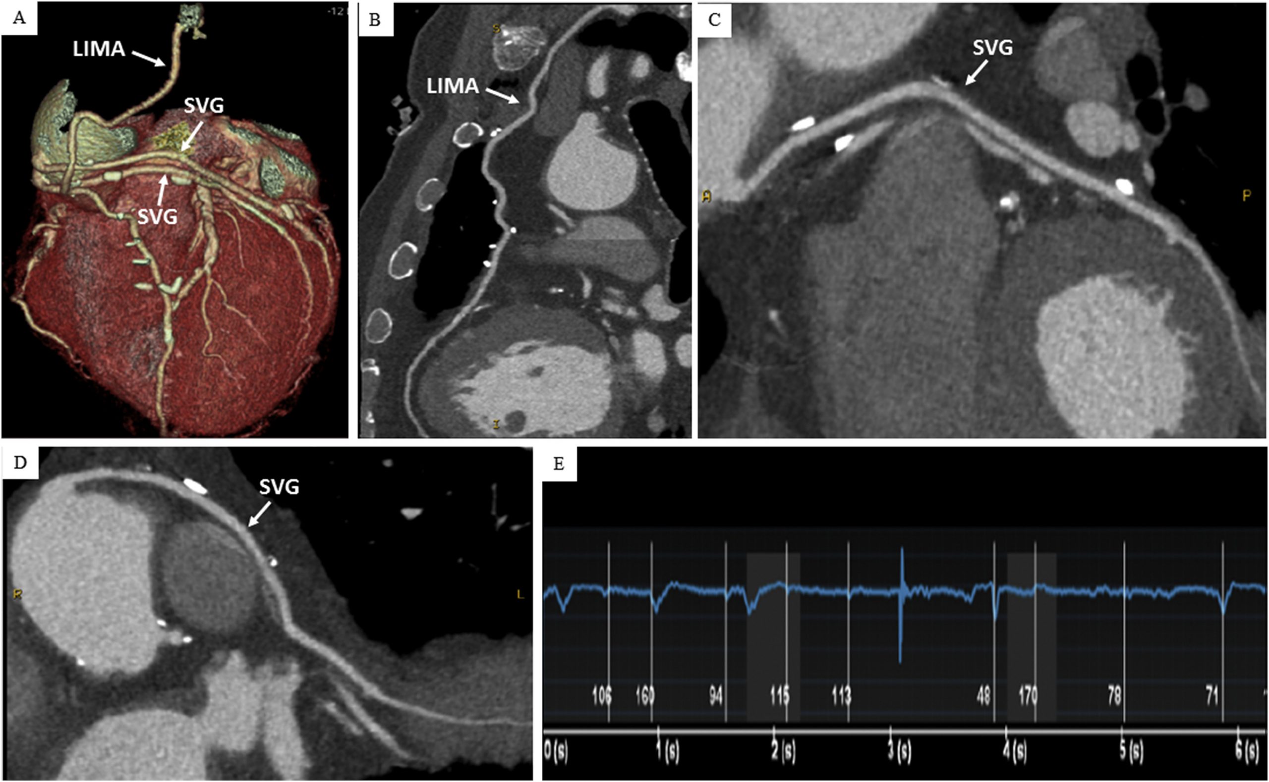 Coronary CT scans are among the tools used to determine risk of heart disease, and adverse events such as sudden cardiac arrest.